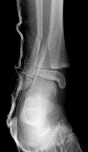 Figure 4 Salter Harris II distal tibia